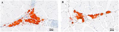 Differences in meat quality between Angus cattle and Xinjiang brown cattle in association with gut microbiota and its lipid metabolism